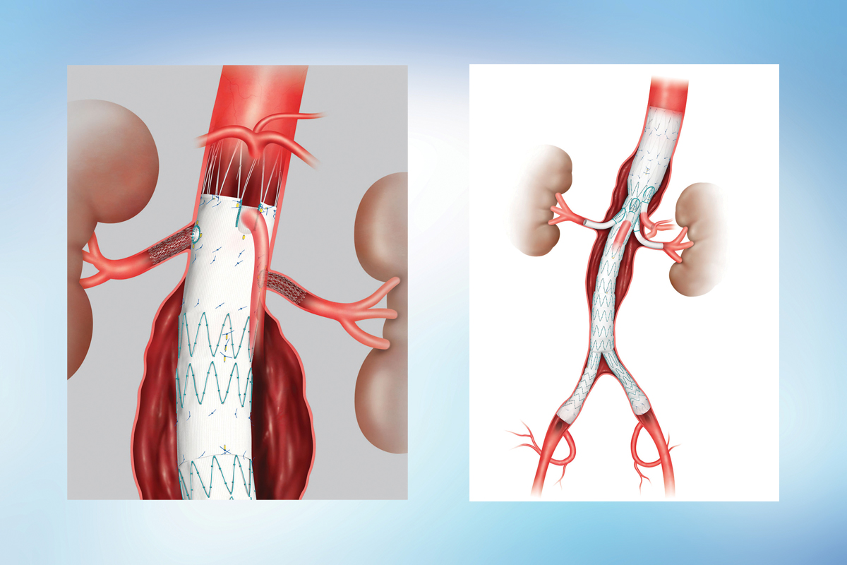 Key Takeaways For Managing Abdominal Aortic Aneurysms Umass Memorial Health The Pursuit 